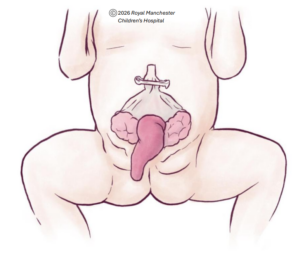 Diagram of Cloacal Exstrophy