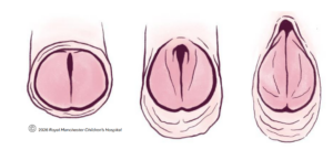 Diagram showing 3 severities of male epispadias