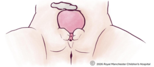 Diagram showing Female Bladder Exstrophy & Epispadias