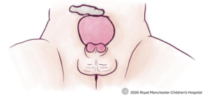 Diagram showing Male Bladder Exstrophy & Epispadias.