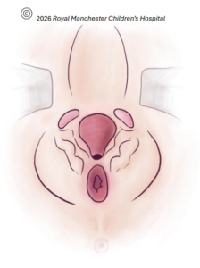 Diagram showing female primary Epispadias