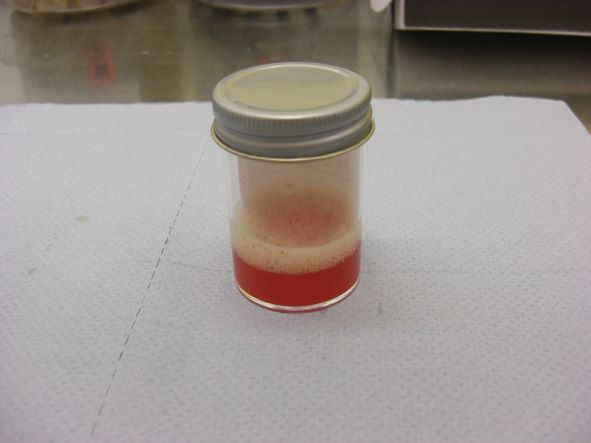 Serous fluid sample