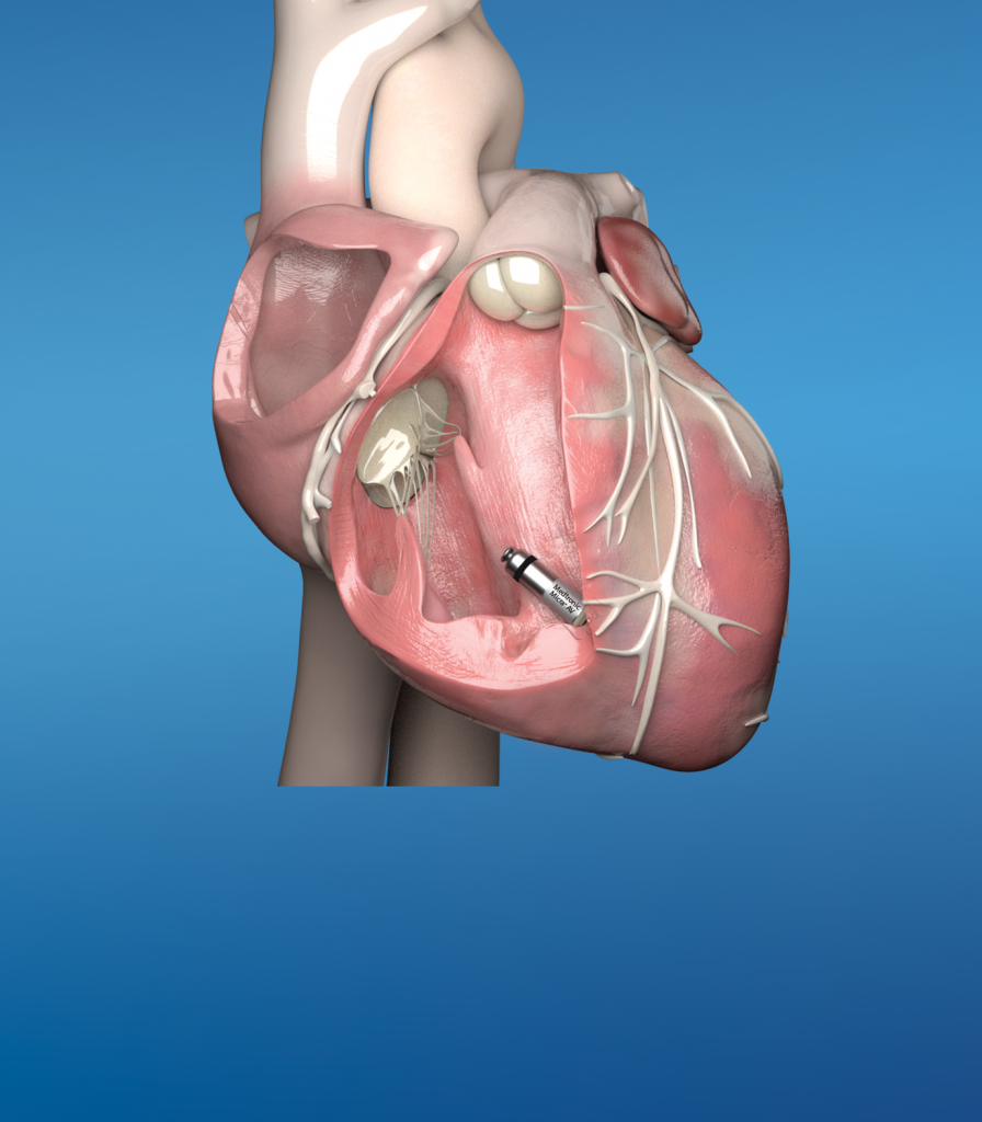 smallest pacemaker Micra_AV_In heart graphic - Wythenshawe Hospital
