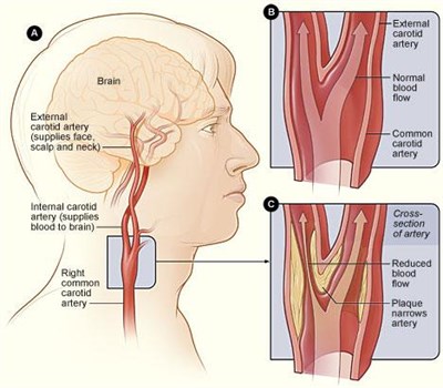 Scan Of The Carotid Arteries Manchester Royal Infirmary