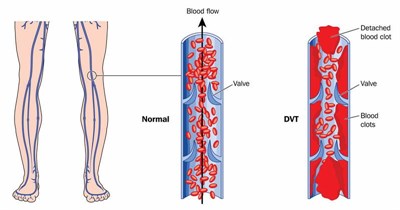 blood clot in leg ultrasound