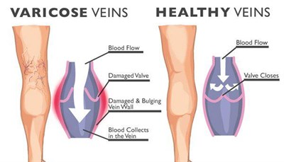 DIAGRAM OF VARICOSE VEINS