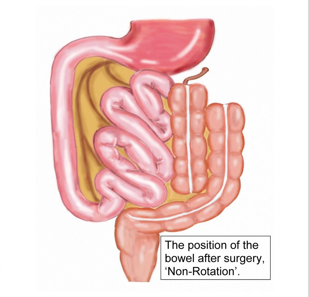 causes-of-intestinal-obstruction