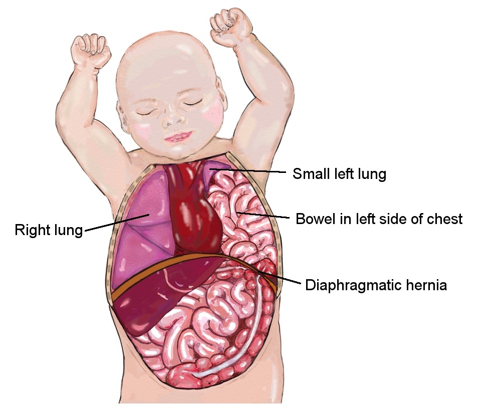 Congenital diaphragmatic hernia (CDH) - Royal Manchester